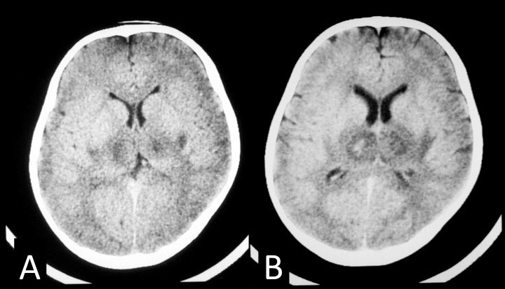 急性壊死性脳症の頭部CT所見