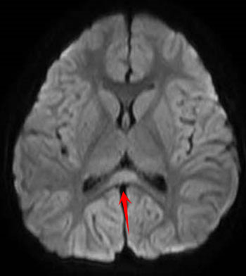 可逆性脳梁膨大部病変を有する軽症脳炎・脳症（MERS）